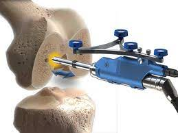 Ο πόνος στο γόνατο αντιμετωπίζεται στη Γενική Κλινική ΟΛΥΜΠΙΟΝ με το νέο χειρουργικό σύστημα ρομποτικής τεχνολογίας Smith and Nephew NAVIO system