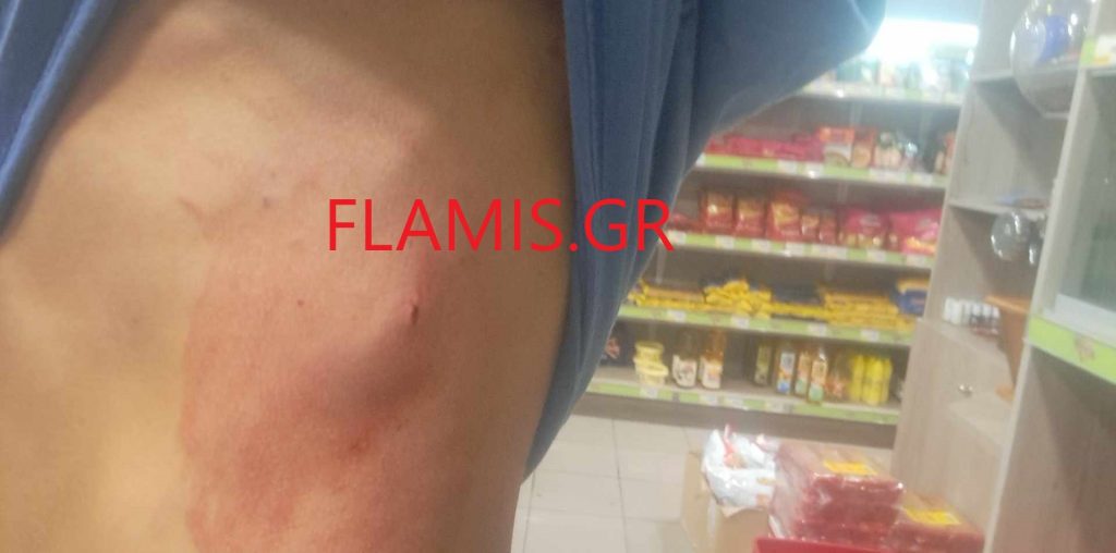 "ΨΥΧΩ" ΣΤΟΝ ΚΟΜΒΟ ΚΟΥΡΤΕΣΗ: 13χρονα κυνηγούσαν και μαχαίρωναν 33χρονα! Σε κάμερα η επίθεση - ΦΩΤΟ ΝΤΟΚΟΥΜΕΝΤΟ