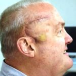 Καρκίνος του εγκεφάλου: Νέα θεραπεία συρρίκνωσε θανατηφόρο όγκο κατά 50% σε μόλις 6 εβδομάδες