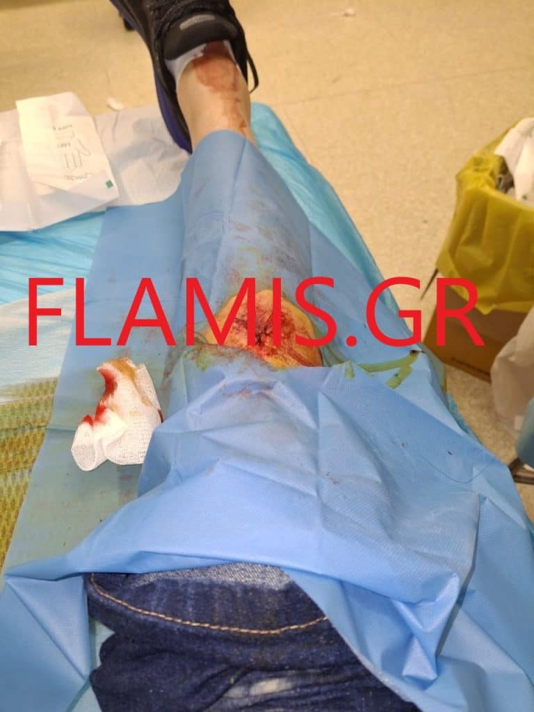 "Αιλουροι" οι ρομά που έκλεψαν την 52χρονη αθλήτρια στίβου! Δείτε πώς έγινε μετά το συμβάν στο Σούλι! καρέ καρέ όσα συνέβησαν "Αιλουροι" οι ρομά που έκλεψαν την 52χρονη αθλήτρια στίβου! Δείτε πώς έγινε μετά το συμβάν στο Σούλι! καρέ καρέ όσα συνέβησαν