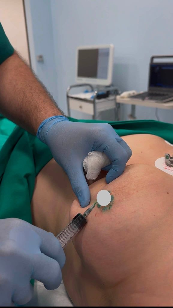 Ένα σημαντικό ορόσημο για τη χειρουργική μαστού στην περιοχή της Πάτρας