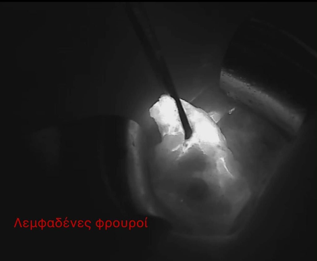 Ένα σημαντικό ορόσημο για τη χειρουργική μαστού στην περιοχή της Πάτρας